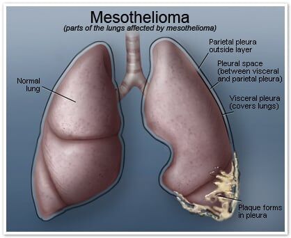 Mesothelioma in the lungs